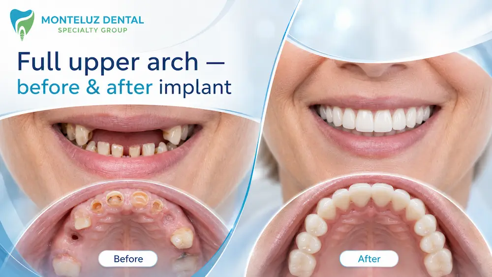 Full upper arch — before & after