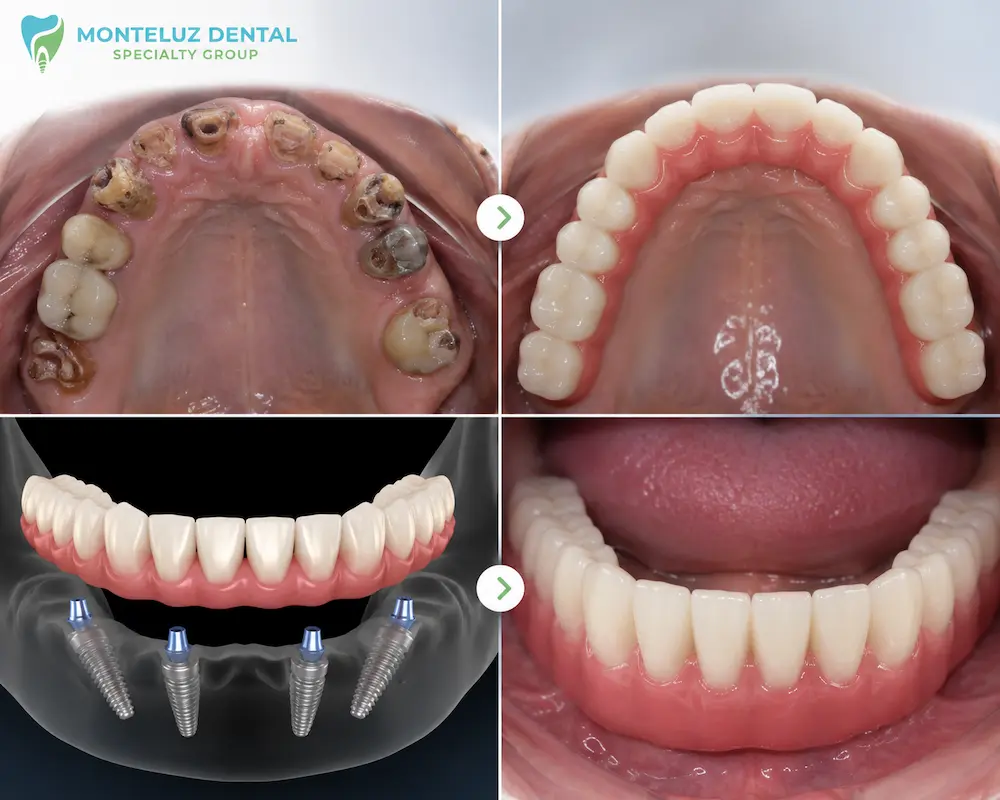All-on-4 lower arch result