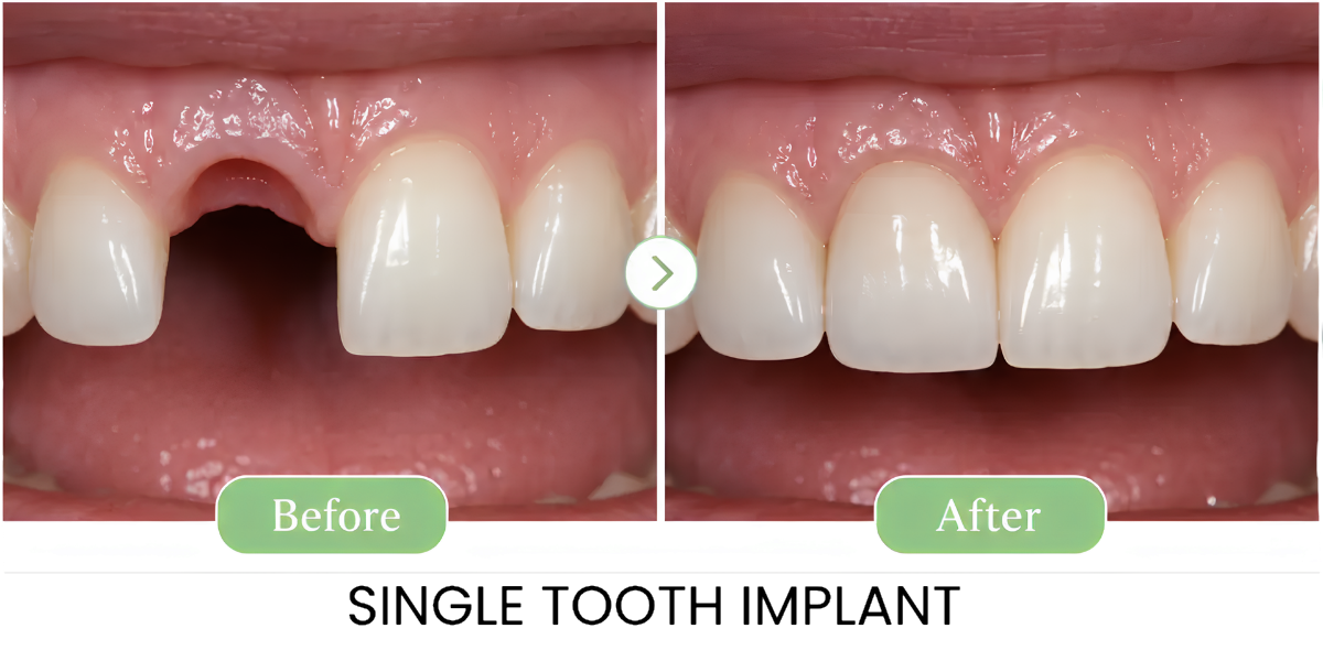 Single tooth implant — before & after