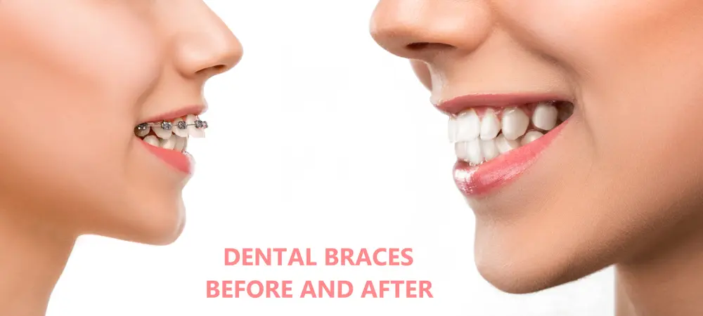 Dental braces before and after