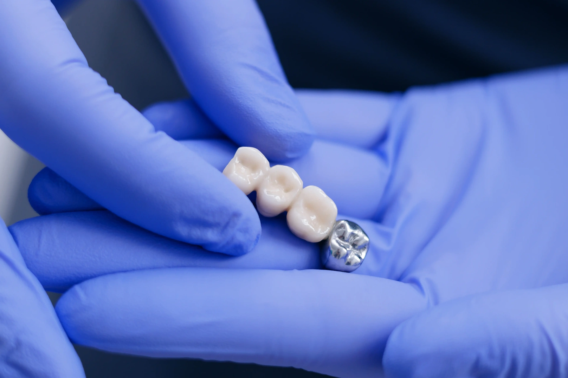 Dental Bridges