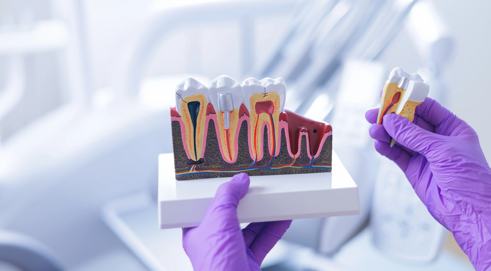 Endodontics (Root Canals)