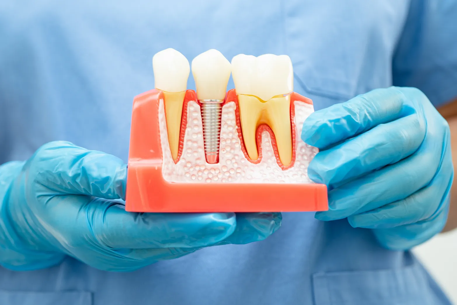 Dental Implants