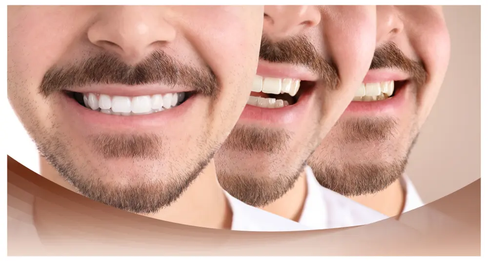 Smile restoration before and after