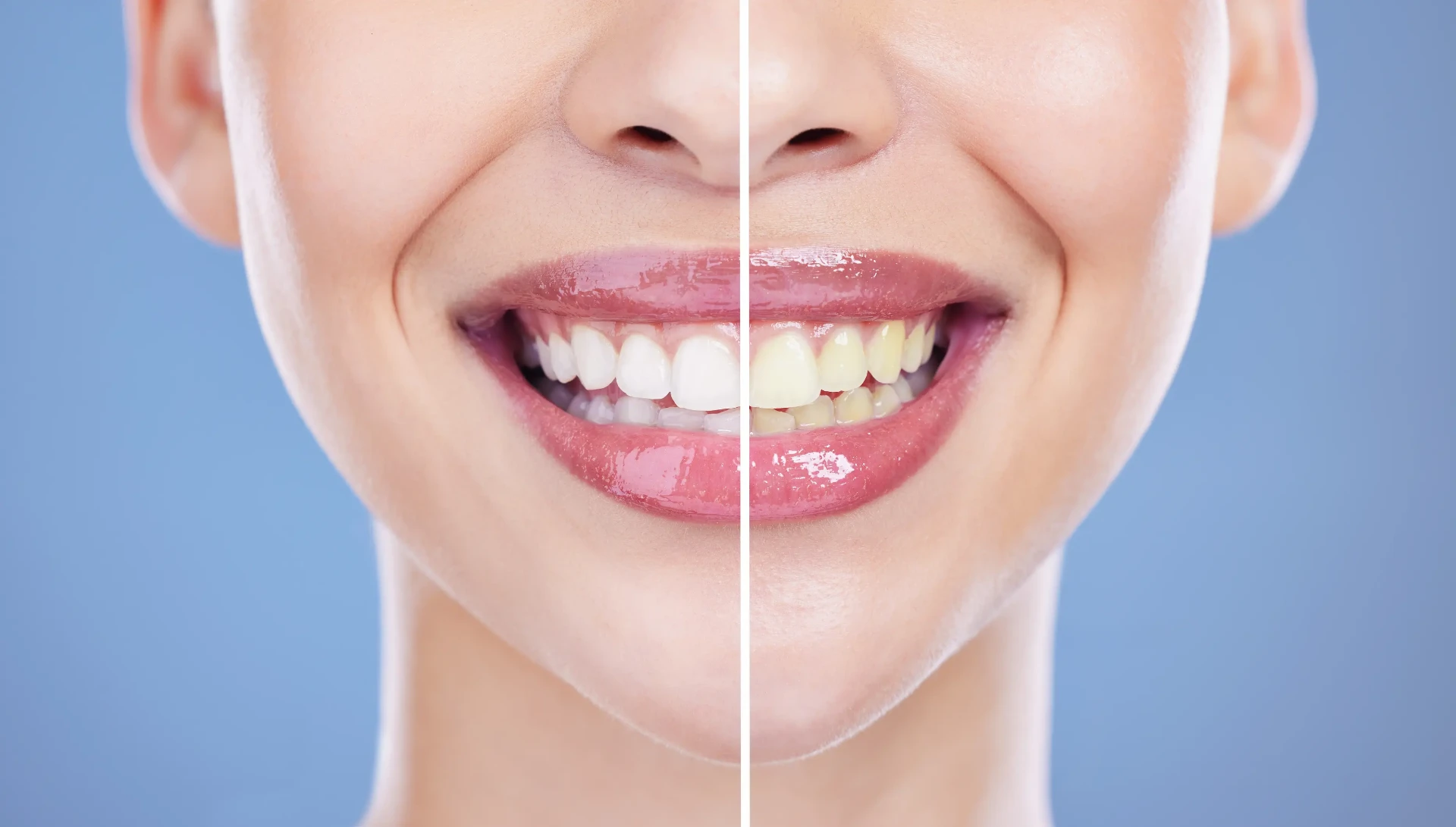 Teeth Whitening